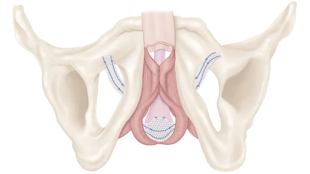 Medical illustration showing a pelvic bone with mesh implants and pelvic floor muscles, viewed from above, illustrating a surgical approach to pelvic organ support and repair.
