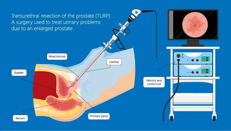 Medical illustration showing the Transurethral Resection of the Prostate (TURP) procedure with a resectoscope inserted through the urethra to the prostate, diagram of internal organs, and a monitor displaying the prostate.