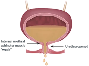 Diagram of the bladder showing urine flow through the internal urethral sphincter (labeled closed) and out the urethra opening, illustrating the process of urination.