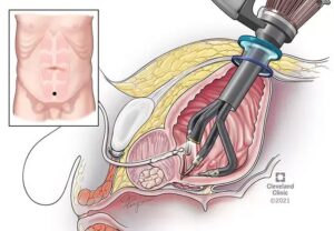 Radial prostatectomy